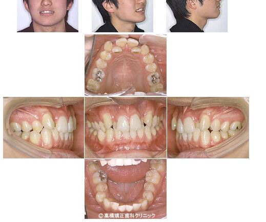 歯を抜かずに叢生（でこぼこ）を治療した症例