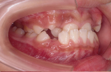 下顎前突[かがくぜんとつ] 受け口、上の歯より下の歯が前にでて顎が出て見える