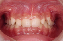 過蓋咬合[かがいこうごう]　上下の歯が深く重なり片顎の歯が見えない