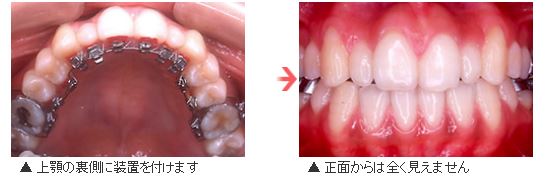 舌側矯正装置の装着写真