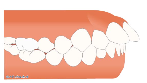 (1)上顎前突(出っ歯)