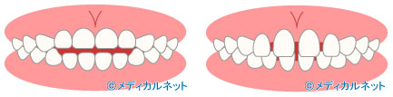 (4)そのほかの不正咬合について(左:開咬 右:すきっ歯)