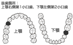 抜歯箇所