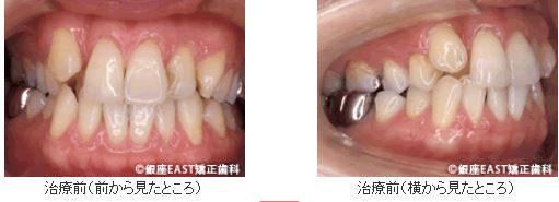 矯正治療後治療前