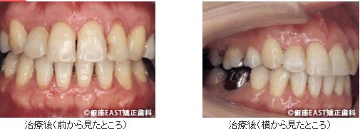 矯正治療後治療後