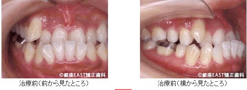 矯正治療後治療前