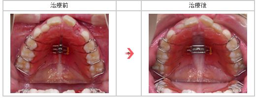 下顎側方拡大装置(拡大床)