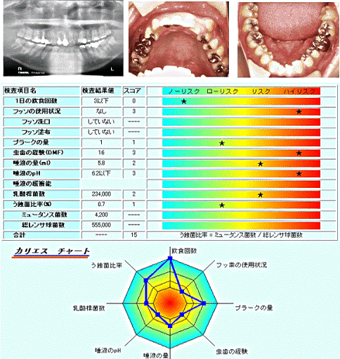 A.　虫歯になりやすい方　（抜髄した歯6本、修復した歯16本：総合スコア15）