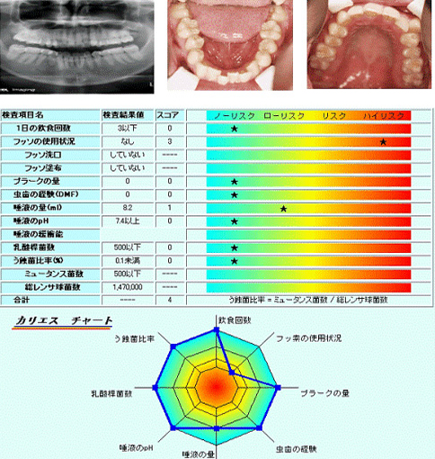 B.　虫歯になりにくい方　（カリエスフリー/今まで虫歯経験ゼロ：総合スコア4）