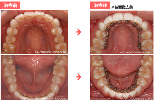 治療前後の比較 (口蓋・舌側)