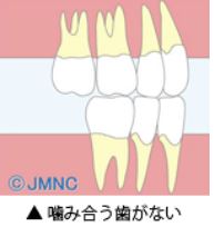 まっすぐ生えていない場合 