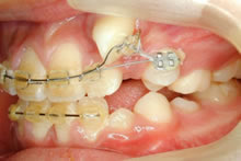 小児矯正症例写真 大人の歯にはえかわりつつあるお子様の治療