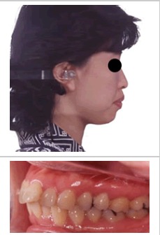 【症例写真】 歯の凸凹と上下顎前突を治療した例 (30代女性)治療前