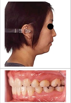【症例写真】 歯の凸凹と上下顎前突を治療した例 (30代女性)治療後
