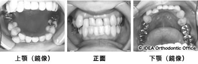 【症状】 上顎前歯の反対咬合
