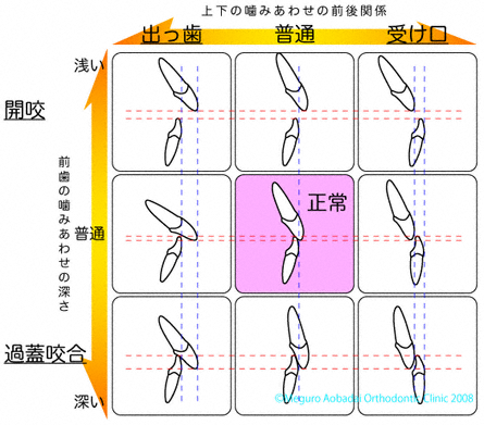 かみ合わせの深さと上下の咬みあわせの前後関係