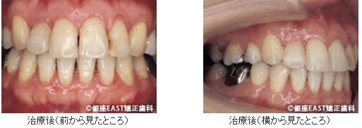 【診断】 4本抜歯して治療を開始治療後