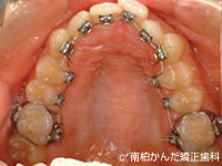 20代矯正治療症例治療前