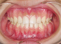CASE2：成人（永久歯が生えそろった方）の症例治療後