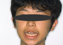 CASE2：成人（永久歯が生えそろった方）の症例治療前