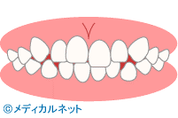 歯並び診断