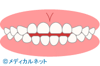 イラストで自己診断 歯並び 噛み合わせを知ろう 矯正歯科ネット