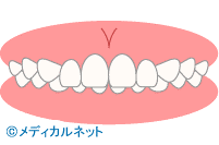 歯並び診断