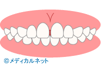 歯並び診断