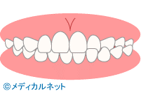 歯並び診断