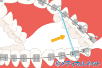 代表的なゴムのかけ方