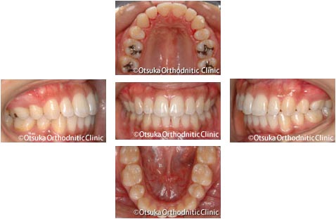 出っ歯の裏側矯正～上顎前歯の突出感と下顎のガタつき～(治療後)