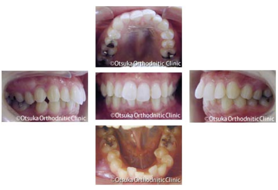 出っ歯の裏側矯正～上顎前歯の突出感と下顎のガタつき～(治療前)