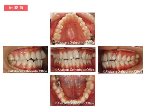 治療前 上の前歯の突出と叢生（でこぼこ）の症例