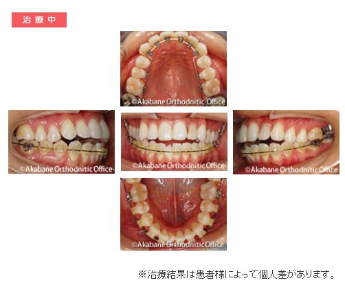 治療中 上の前歯の突出と叢生（でこぼこ）の症例