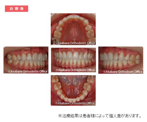 治療後 上の前歯の突出と叢生（でこぼこ）の症例
