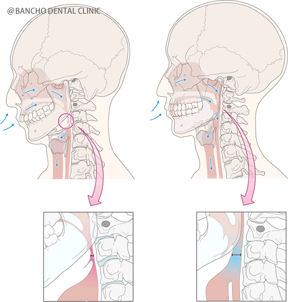 噛み合わせが深く、顎が奥に入り顎関節症になってしまった患者さんの矯正治療で行うプロセス