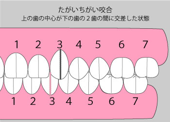 たがいちがい咬合