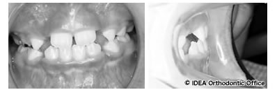 上顎の中切歯が正常被蓋になり通院間隔を長く調整（8歳10カ月）