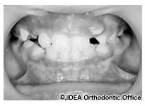 上顎右側の側切歯（永久歯2番）が正常被蓋に（10歳8カ月）