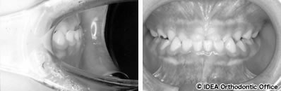 【症状】 乳歯歯列期の反対咬合