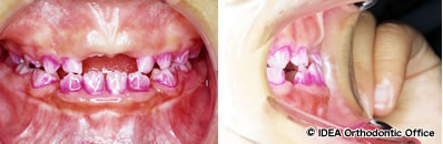 上顎前歯の乳歯が抜けた状態（8歳2カ月）