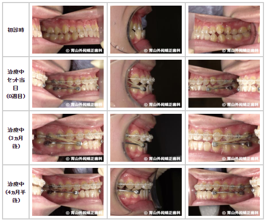 下顎の歯を移動する装置 下顎用の大臼歯遠心移動装置 を使用した症例 矯正歯科ネット