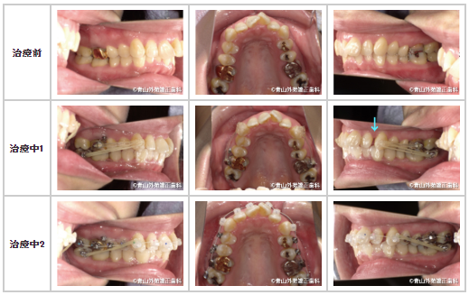非抜歯治療の強い味方 奥歯を後ろに下げる矯正装置 大臼歯遠心移動装置 の治療について 矯正歯科ネット
