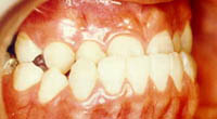 歯並びが悪いとどうなるの？（3）見た目への影響2治療前