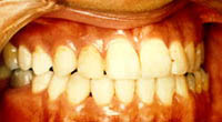 歯並びが悪いとどうなるの？（3）見た目への影響2治療後