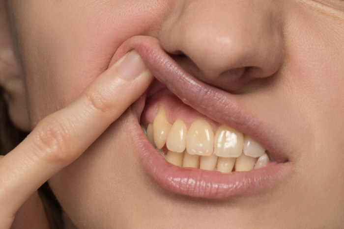 ガミースマイルの原因は３つ あなたはどのタイプ 矯正歯科ネット