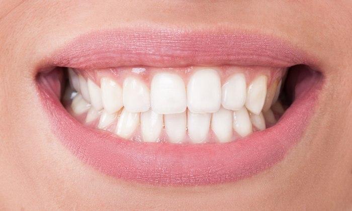 歯が生え揃わなかった、歯の大きさが小さい場合、歯茎が大きくなってしまっている場合もガミースマイルの原因
