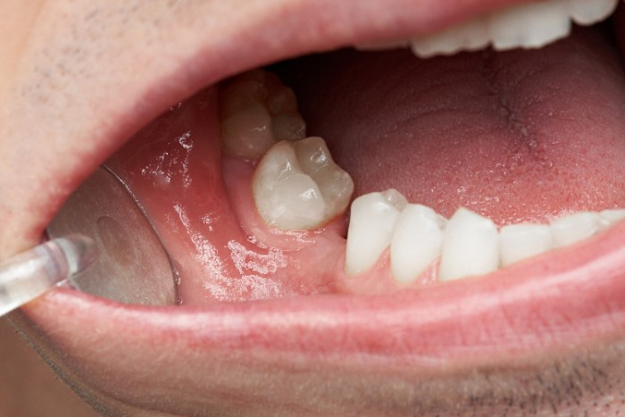矯正治療では歯を調整をすることで最終的に隙間は埋まりますが、整形は歯と歯の隙間が残ることもあります。