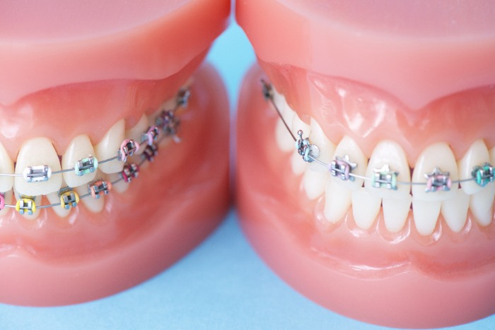 歯列矯正のみで歯並びを整えられるケースもありますが、骨格に原因がある場合は歯列矯正では口ゴボを治すことは出来ません。