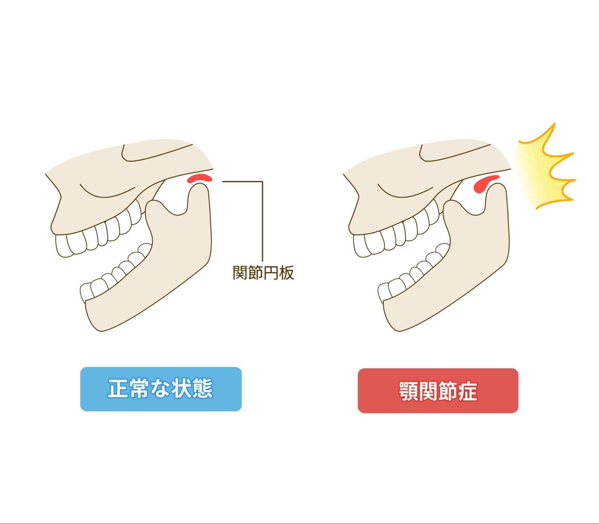 顎 ズレ 噛み 合わせ